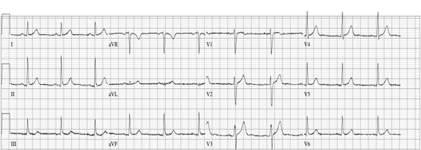 ECG